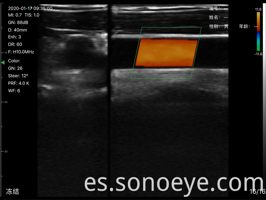 wirelss ultrasound